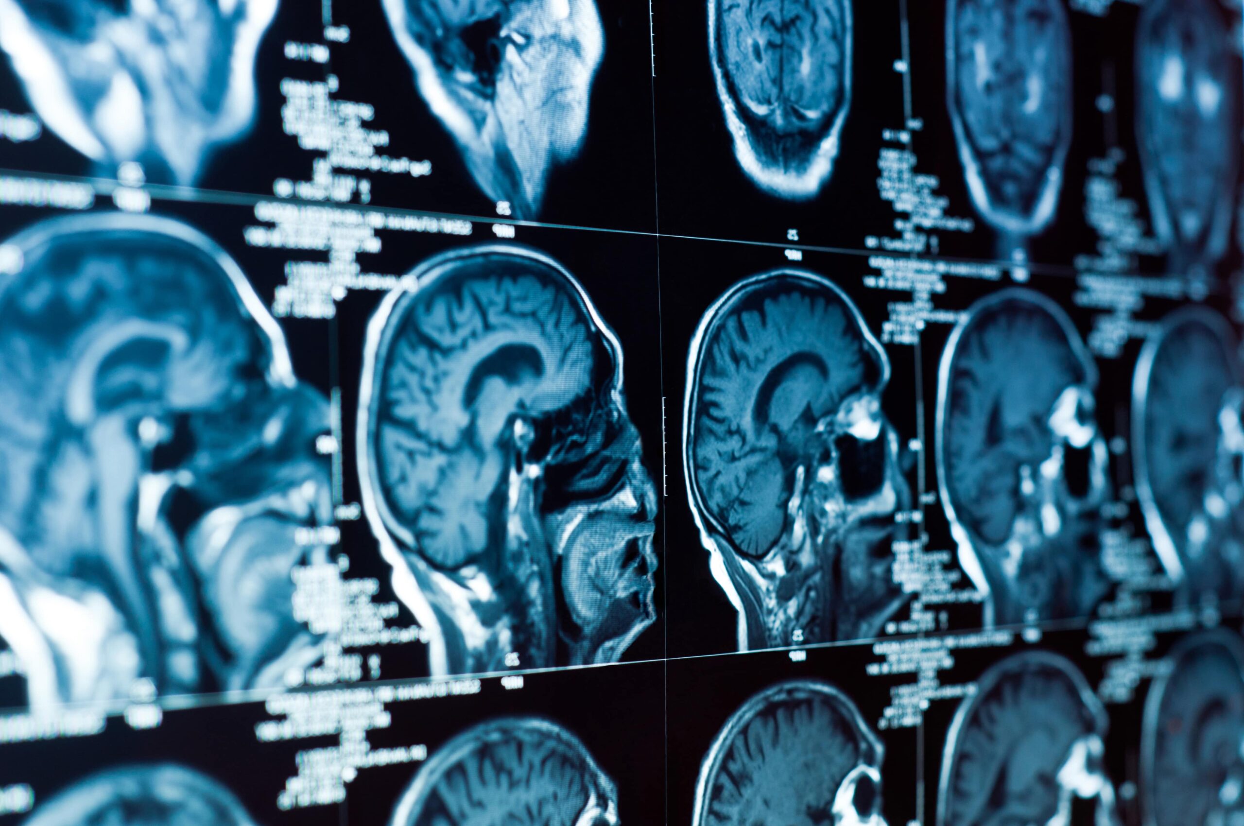 Read more about the article The Crucial Role Of Brain Injury Lawyers